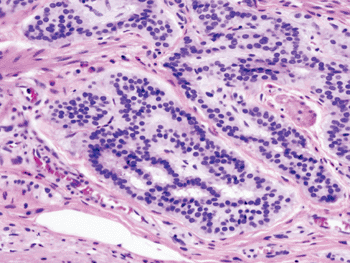 Image: Histopathology of colonic carcinoid (Photo courtesy of Free Software Foundation).